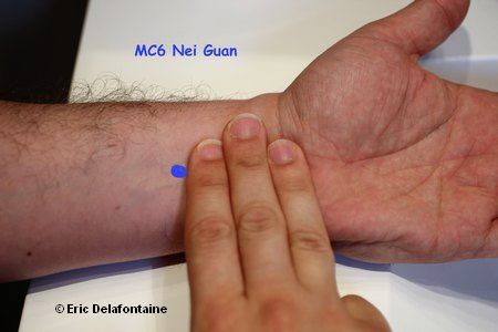 Un point d'acupuncture (MC6) contre le mal des transports