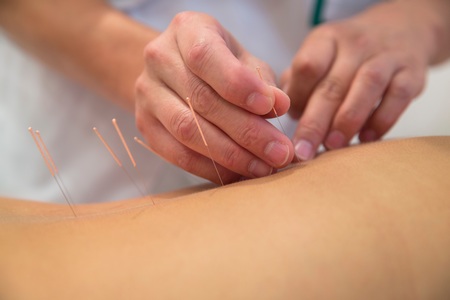 Acupuncture médecine chinoise